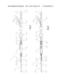 INTRODUCER FOR AN ILIAC SIDE BRANCH DEVICE diagram and image