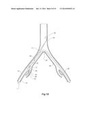 INTRODUCER FOR AN ILIAC SIDE BRANCH DEVICE diagram and image