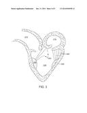 SYNTHETIC CHORD FOR CARDIAC VALVE REPAIR APPLICATIONS diagram and image