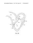 SYNTHETIC CHORD FOR CARDIAC VALVE REPAIR APPLICATIONS diagram and image