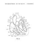 SYNTHETIC CHORD FOR CARDIAC VALVE REPAIR APPLICATIONS diagram and image