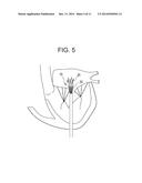 TRUNCATED CONE HEART VALVE STENT diagram and image