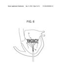 TRUNCATED CONE HEART VALVE STENT diagram and image