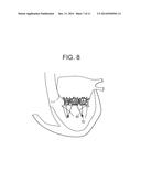 TRUNCATED CONE HEART VALVE STENT diagram and image