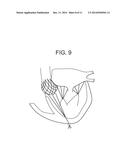 TRUNCATED CONE HEART VALVE STENT diagram and image