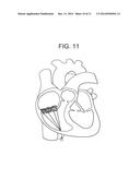 TRUNCATED CONE HEART VALVE STENT diagram and image