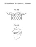 TRUNCATED CONE HEART VALVE STENT diagram and image