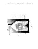 ELBOW ANTIBIOTIC SPACER IMPLANT diagram and image