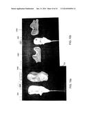 ELBOW ANTIBIOTIC SPACER IMPLANT diagram and image