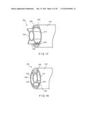 Graft Collection and Containment System for Bone Defects diagram and image