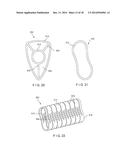 Graft Collection and Containment System for Bone Defects diagram and image