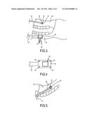 PATIENT INTERFACE DEVICE FIXABLE TO THE PATIENT VIA A BONE ANCHOR INSIDE     THE PATIENT S MOUTH diagram and image