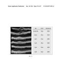 TREATMENT OF AMD USING AAV SFLT-1 diagram and image