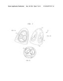 VENTRICULAR ASSIST DEVICE FOR INTRAVENTRICULAR PLACEMENT diagram and image