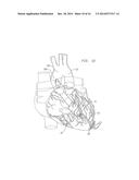 VENTRICULAR ASSIST DEVICE FOR INTRAVENTRICULAR PLACEMENT diagram and image