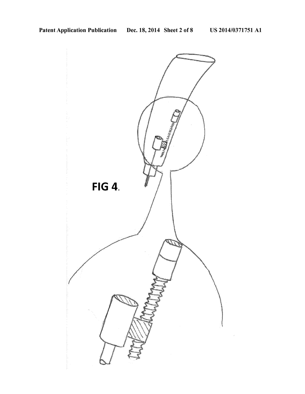 Medical Device for Controlled Nail Penetration - diagram, schematic, and image 03