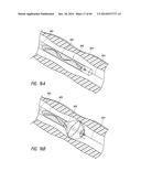 IMPLANTABLE LUMINAL DEVICES diagram and image