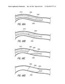 IMPLANTABLE LUMINAL DEVICES diagram and image