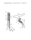CLOT RETRIEVAL DEVICE FOR REMOVING OCCLUSIVE CLOT FROM A BLOOD VESSEL diagram and image