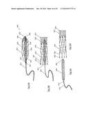 CLOT RETRIEVAL DEVICE FOR REMOVING OCCLUSIVE CLOT FROM A BLOOD VESSEL diagram and image