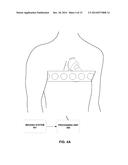 METRICS OF ELECTRICAL DYSSYNCHRONY AND ELECTRICAL ACTIVATION PATTERNS FROM     SURFACE ECG ELECTRODES diagram and image