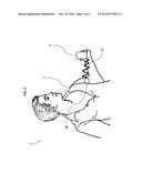 STIMULATION DEVICE AND METHOD OF USE THEREOF diagram and image