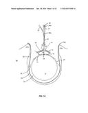 SYSTEM THAT SECURES AN ELECTRODE ARRAY TO THE SPINAL CORD FOR TREATING     BACK PAIN diagram and image