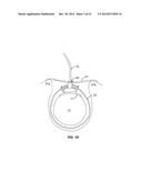 SYSTEM THAT SECURES AN ELECTRODE ARRAY TO THE SPINAL CORD FOR TREATING     BACK PAIN diagram and image