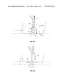 SYSTEM THAT SECURES AN ELECTRODE ARRAY TO THE SPINAL CORD FOR TREATING     BACK PAIN diagram and image