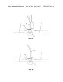 SYSTEM THAT SECURES AN ELECTRODE ARRAY TO THE SPINAL CORD FOR TREATING     BACK PAIN diagram and image