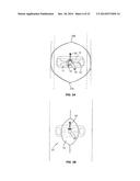 SYSTEM THAT SECURES AN ELECTRODE ARRAY TO THE SPINAL CORD FOR TREATING     BACK PAIN diagram and image