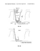 SYSTEM THAT SECURES AN ELECTRODE ARRAY TO THE SPINAL CORD FOR TREATING     BACK PAIN diagram and image