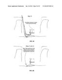 SYSTEM THAT SECURES AN ELECTRODE ARRAY TO THE SPINAL CORD FOR TREATING     BACK PAIN diagram and image