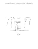 SYSTEM THAT SECURES AN ELECTRODE ARRAY TO THE SPINAL CORD FOR TREATING     BACK PAIN diagram and image