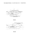 SYSTEM THAT SECURES AN ELECTRODE ARRAY TO THE SPINAL CORD FOR TREATING     BACK PAIN diagram and image