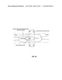 SYSTEM THAT SECURES AN ELECTRODE ARRAY TO THE SPINAL CORD FOR TREATING     BACK PAIN diagram and image