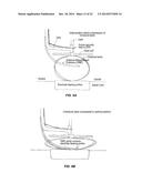 SYSTEM THAT SECURES AN ELECTRODE ARRAY TO THE SPINAL CORD FOR TREATING     BACK PAIN diagram and image