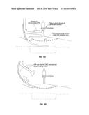 SYSTEM THAT SECURES AN ELECTRODE ARRAY TO THE SPINAL CORD FOR TREATING     BACK PAIN diagram and image