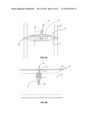 SYSTEM THAT SECURES AN ELECTRODE ARRAY TO THE SPINAL CORD FOR TREATING     BACK PAIN diagram and image