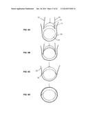 SYSTEM THAT SECURES AN ELECTRODE ARRAY TO THE SPINAL CORD FOR TREATING     BACK PAIN diagram and image