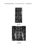 SYSTEM THAT SECURES AN ELECTRODE ARRAY TO THE SPINAL CORD FOR TREATING     BACK PAIN diagram and image