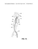 EXPANDABLE SUPPORTIVE ENDOLUMINAL STENT GRAFT diagram and image