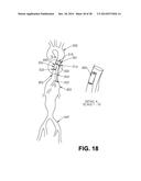 EXPANDABLE SUPPORTIVE ENDOLUMINAL STENT GRAFT diagram and image