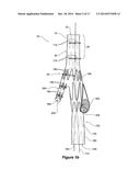 ENDOVASCULAR GRAFT WITH AN EXPANDED LUMEN AT A BIFURCATION diagram and image