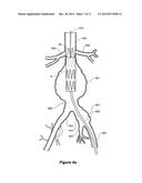 ENDOVASCULAR GRAFT WITH AN EXPANDED LUMEN AT A BIFURCATION diagram and image