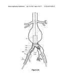 ENDOVASCULAR GRAFT WITH AN EXPANDED LUMEN AT A BIFURCATION diagram and image