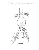 ENDOVASCULAR GRAFT WITH AN EXPANDED LUMEN AT A BIFURCATION diagram and image