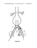 ENDOVASCULAR GRAFT WITH AN EXPANDED LUMEN AT A BIFURCATION diagram and image