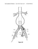 ENDOVASCULAR GRAFT WITH AN EXPANDED LUMEN AT A BIFURCATION diagram and image