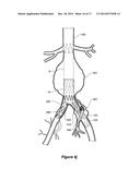 ENDOVASCULAR GRAFT WITH AN EXPANDED LUMEN AT A BIFURCATION diagram and image